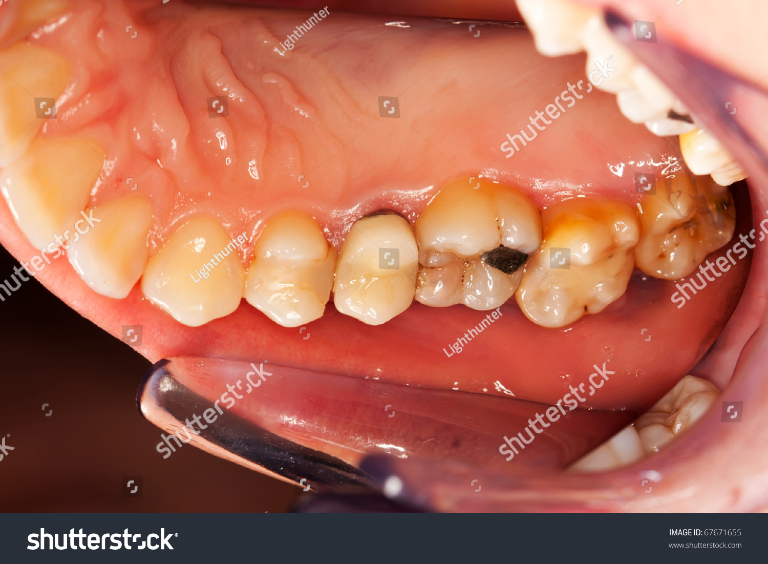 上hemiarcade(牙齿口腔表面),一个前磨牙冠,蛀牙,牙龈的感情,馅料和
